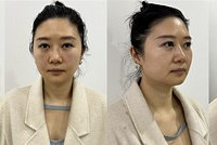 试试这个方法!快速淡化法令纹,还能让下巴更兜翘
