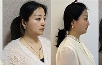 试试这个抗衰项目,淡法令纹还能变小脸