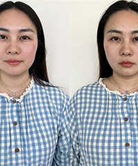 拯救垮脸!肉肉脸小一圈,还淡化法令纹