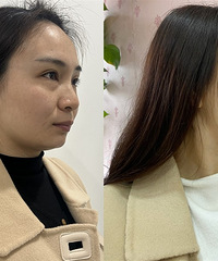 这种祛眼袋方法居然不动刀!创伤小、恢复快、还即做即走,太棒了