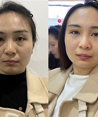 不动刀也能祛眼袋,7天后变化真大