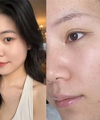 油痘肌来说,做3次黄金微针的真实效果