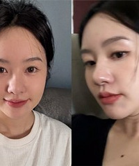 体验超声炮,没想象中痛,但效果确实好