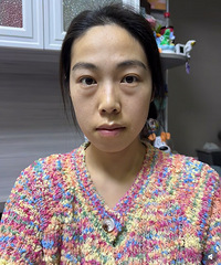 眼袋超级大,29岁看着好像39岁!祛掉之后,不化妆都很精神