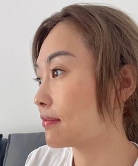 嗨体2.5+黄金超光子,是我皮肤越来越好的定期保养方式