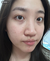换季容易脸红,做了光子嫩肤后,改善好多!性价比真的高