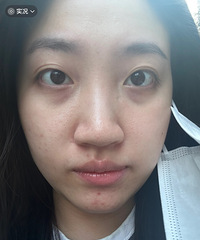换季容易脸红,做了光子嫩肤后,改善好多!性价比真的高
