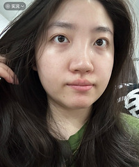 面部发红好不舒服,光子嫩肤真的性价比超高