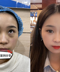 没想到遗传性大眼袋,不用开动也能祛掉!瞬间年轻好几岁