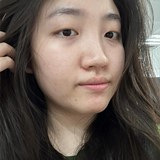 光子嫩肤真能淡红血丝