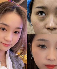 遗传性大眼袋,也能不动刀改善