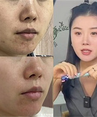 终于治好我的痘坑痘印,现在皮肤太好了