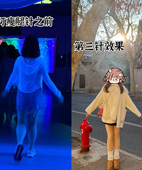 家族遗传的肌肉腿,记录打了三次瘦腿针的变化,真细了不少