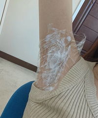 夏天腋下流汗不止,还有异味!做了这个治疗,能清爽度过6个月
