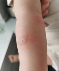 蚊子叮咬之后怎么消肿