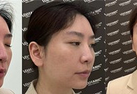 痘肌都能做的黄金微针,缩毛孔,改善肤质