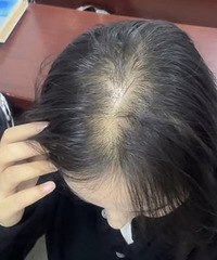 服了...出门看到很多女生的头顶都有大发缝!都是怎么回事