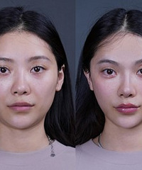 谁说“换头”一定要动刀子?