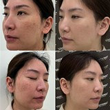 痘肌也能抗老和嫩肤