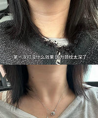 颈纹深也不怕!做了4次嗨体,现在的脖子在阳光下都看不到纹