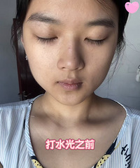 坚持抗炎真的会让皮肤变好!做了这个水光,皮肤真变白了