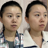 终于治好我的痘坑痘印