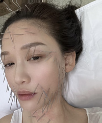女明星真不是谁都可以当的!为了变美,居然全脸做了针雕