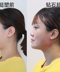 个人觉得这个方法消除双下巴,真的巨快!不信看看我的变化