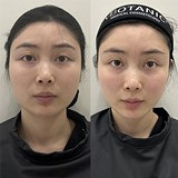 美拉美的瘦脸效果真绝