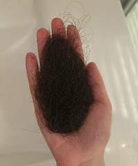 疯狂掉发后,开始尝试空心针针灸治疗,扎了头顶和肚子,居然不痛