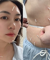 替你们试了一下针灸美容和减肥