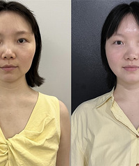 真心建议想要抗衰就试试这个,松弛下垂的脸,做一次就提升紧致了