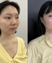 真心建议想要抗衰就试试这个,松弛下垂的脸,做一次就提升紧致了