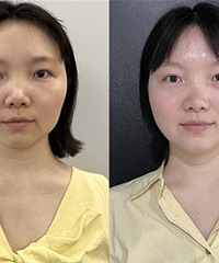 抗衰就试试这个!拯救松弛下垂脸