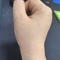 针灸一次治好我的囊肿