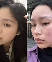 我的黑眼圈、细纹、假性眼袋,真没了