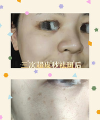 û뵽ô򵥣ȸߣ3γƤ룬͸㶨