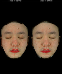做黄金微针20天后去复查,用3D皮肤检测仪看看真实皮肤变化