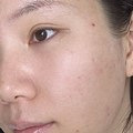 黄金微针一年三次效果