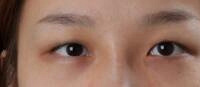 只是做了双眼皮,没想到改变这么大!看上去真的很自然