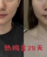 做完热玛吉28天,给大家看看真实变化!提前做好攻略,价格很划