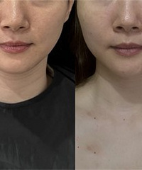 看看做完热玛吉28天后的变化
