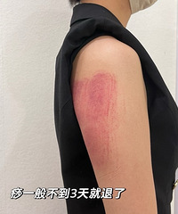 做了6次超塑瘦手臂,我有真实发言权!