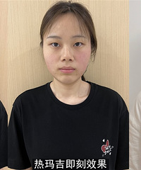 做完热玛吉一周后,面部能有怎样的改变?即刻效果就让我很意外