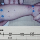 爱喝奶的娃竟牛奶过敏