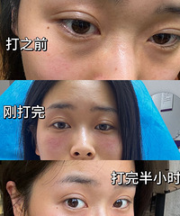 泪沟+轻微眼袋+黑眼圈,我只用780元就解决了!效果好明显