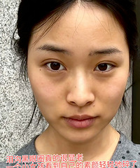 泪沟+轻微眼袋+黑眼圈,我只用780元就解决了!效果好明显