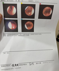 确诊扁桃体肥大三级,只能手术,排队排到年底