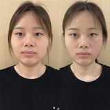热玛吉即刻效果真心好