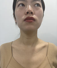 困扰了10年的颈纹,终于把它解决了!7天后的差别就很大
